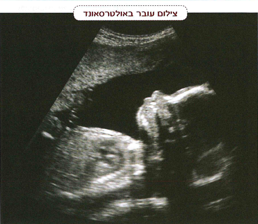 (בספר תמונה:) צילום עובר באולטרסאונד.